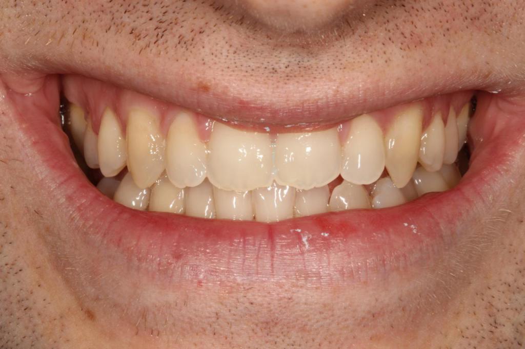 ceramic bracesDr Gurs Sehmi, London