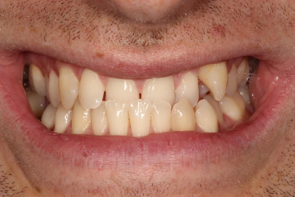 ceramic bracesDr Gurs Sehmi, London