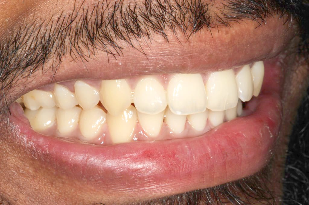 ceramic bracesDr Gurs Sehmi, London