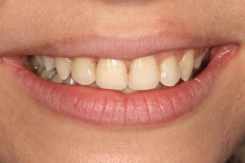 Ceramic Brace treatment London, Dr Gurs Sehmi