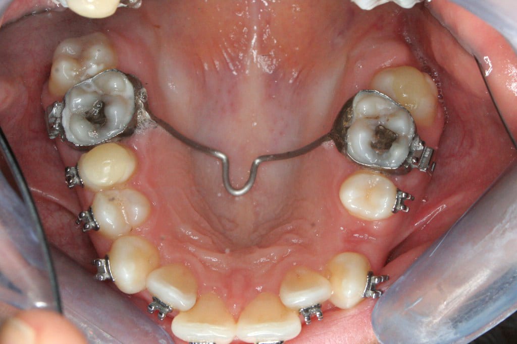 Ceramic Brace treatment London, Dr Gurs Sehmi