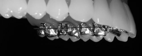 Lingual Braces, Dr Gurs Sehmi, Cosmetic Dentist, London