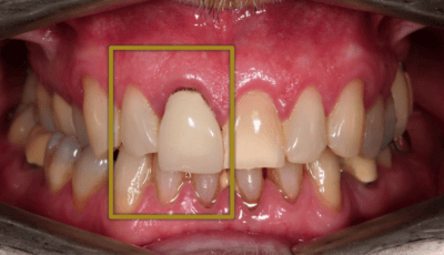 How Many Veneers Do You Need For a Perfect Smile? 3 How Many Veneers Do You Need For a Perfect Smile? 3
