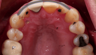 How Many Veneers Do You Need For a Perfect Smile? 4 How Many Veneers Do You Need For a Perfect Smile? 4