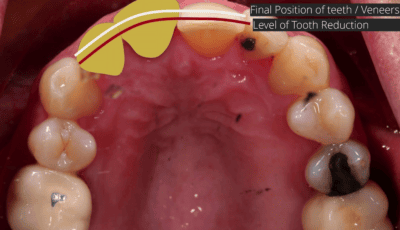 How Many Veneers Do You Need For a Perfect Smile? 5 How Many Veneers Do You Need For a Perfect Smile? 5