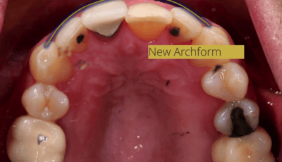How Many Veneers Do You Need For a Perfect Smile? 6 How Many Veneers Do You Need For a Perfect Smile? 6
