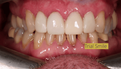 How Many Veneers Do You Need For a Perfect Smile? 7 How Many Veneers Do You Need For a Perfect Smile? 7