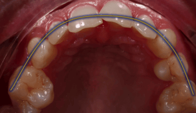 How Many Veneers Do You Need For a Perfect Smile? 8 How Many Veneers Do You Need For a Perfect Smile? 8