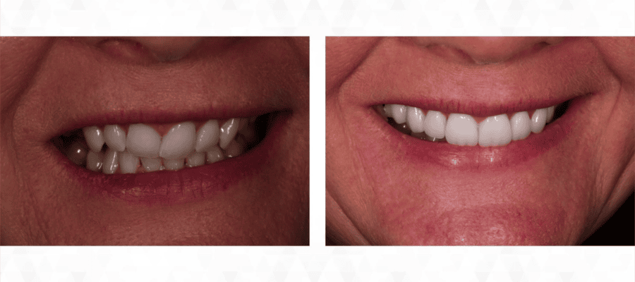 How Many Veneers Do You Need For a Perfect Smile? 9 How Many Veneers Do You Need For a Perfect Smile? 9