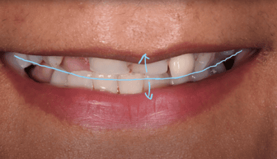 Designing a Perfect Smile - Dr Gurs Sehmi 1 Designing a Perfect Smile - Dr Gurs Sehmi 1