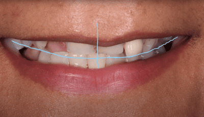Designing a Perfect Smile - Dr Gurs Sehmi 2 Designing a Perfect Smile - Dr Gurs Sehmi 2