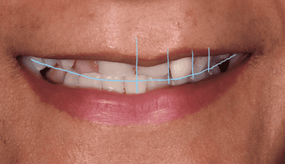 Designing a Perfect Smile - Dr Gurs Sehmi 4 Designing a Perfect Smile - Dr Gurs Sehmi 4