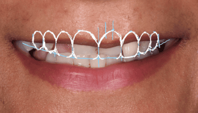 Designing a Perfect Smile - Dr Gurs Sehmi 3 Designing a Perfect Smile - Dr Gurs Sehmi 3