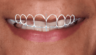 Designing a Perfect Smile - Dr Gurs Sehmi 5 Designing a Perfect Smile - Dr Gurs Sehmi 5
