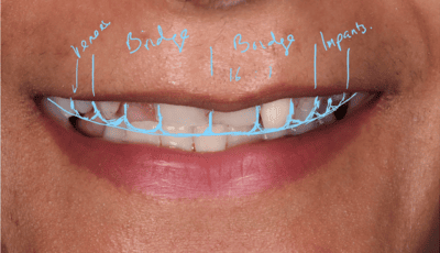 Designing a Perfect Smile - Dr Gurs Sehmi 7 Designing a Perfect Smile - Dr Gurs Sehmi 7