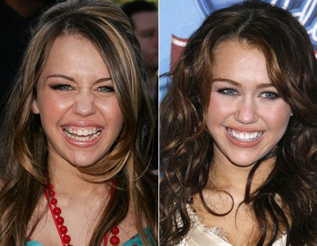 miley-teeth