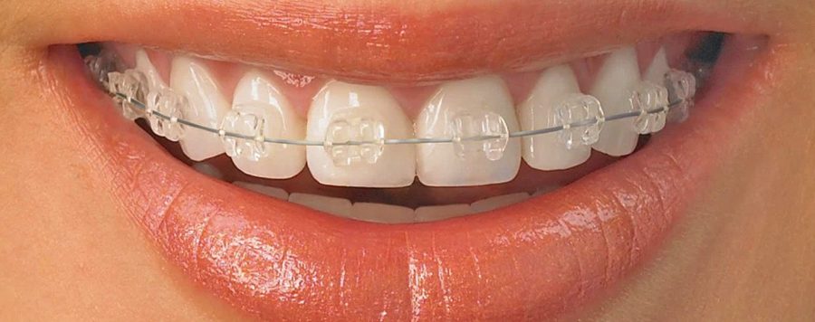 Ceramic braces, Dr Gurs Sehmi, London