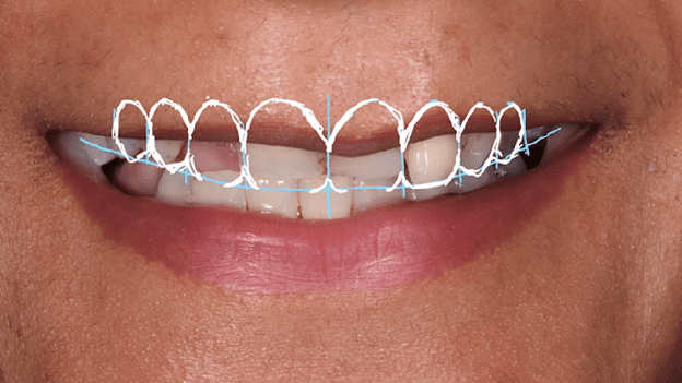 Designing a Perfect Smile - Dr Gurs Sehmi 5